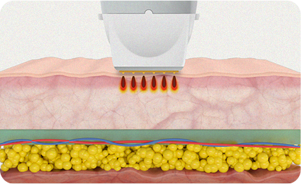 Fractional RF 툴 사진